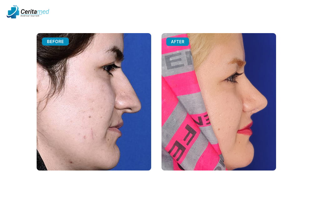 أفضل جراحة تجميل الأنف في إيران للنساء - نتائج طبيعية سریتامد