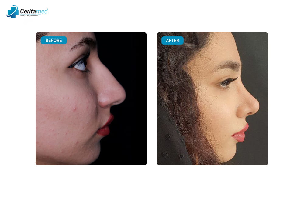 صورة جانبية قبل وبعد تجميل الأنف في إيران توضح إزالة حدبة الأنف والحصول على قوس انسيابي جذاب.