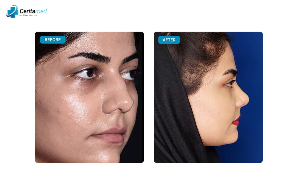 صورة جانبية قبل وبعد لعملية تجميل الأنف في إيران توضح رفع طرف الأنف وتصغير الحجم بشكل متناسق.