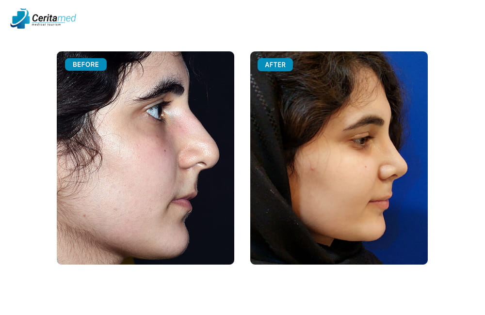 نتيجة عملية تجميل أنف طبيعية جداً في إيران قبل وبعد، تظهر تحسين الجسر والأرنبة.