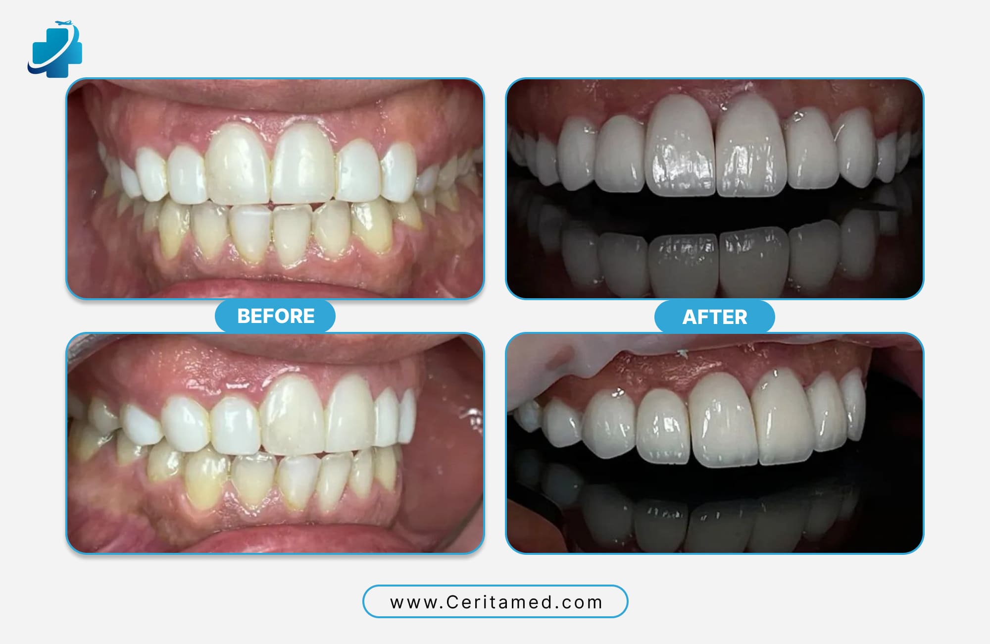 Hollywood Smile Before and After – Misalignment & Shade Correction | Ceritamed