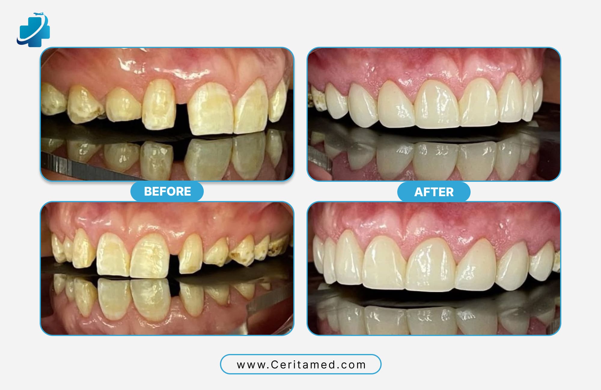 نتائج قبل وبعد ابتسامة هوليود في إيران لتحسين لون وشكل الأسنان في مركز Ceritamed