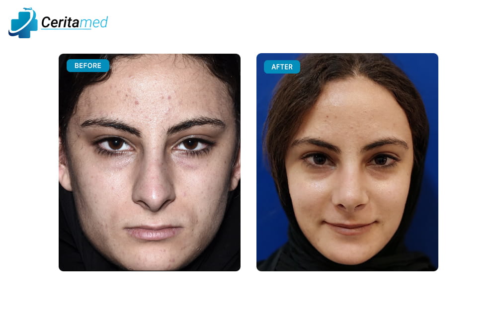 صورة قبل وبعد جراحة تجميل الأنف في إيران تظهر الفرق الواضح في شكل الأنف وتحسينه بعد العملية.