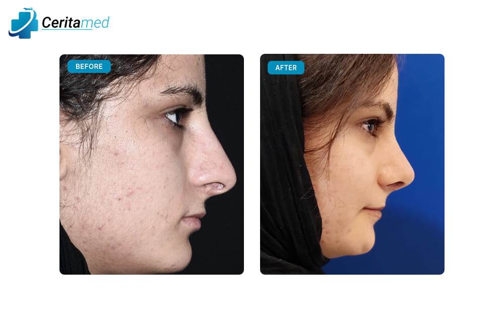 صورة قبل وبعد جراحة تجميل الأنف تظهر التحسينات في شكل الأنف بعد عملية التجميل للنساء في إيران.