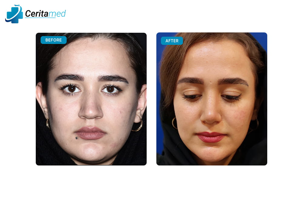صورة قبل وبعد جراحة تجميل الأنف تظهر التحسينات في شكل الأنف بعد عملية التجميل في إيران.