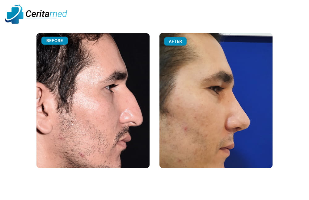 صورة قبل وبعد لعملية تجميل الأنف تظهر التحسينات الجمالية التي حدثت في الأنف بعد الجراحة في إيران.