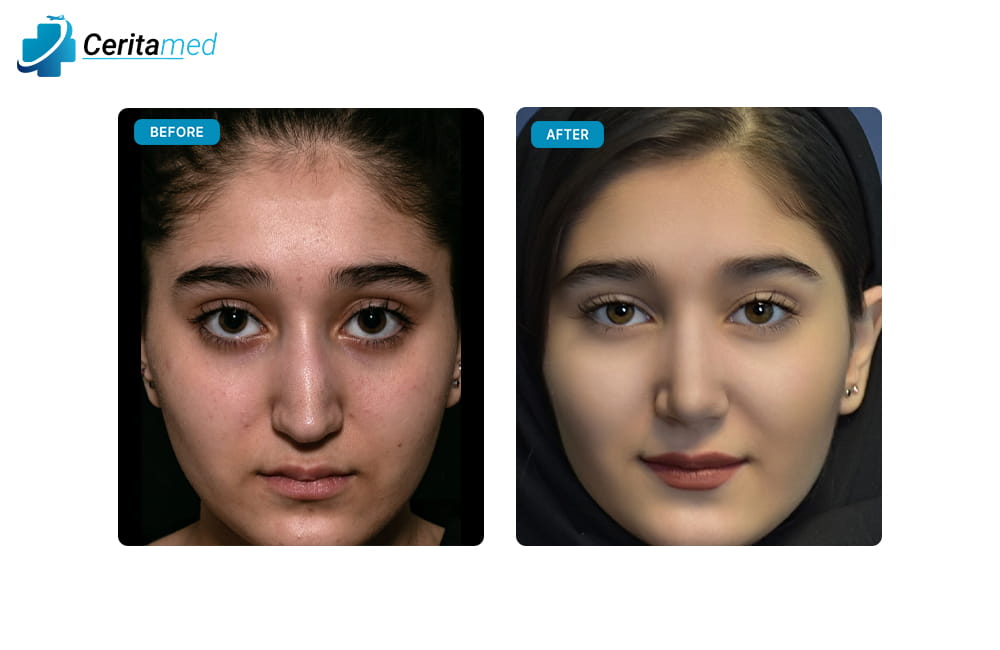 صورة قبل وبعد لعملية تجميل الأنف تظهر التحسن في شكل الأنف بعد الجراحة في إيران.