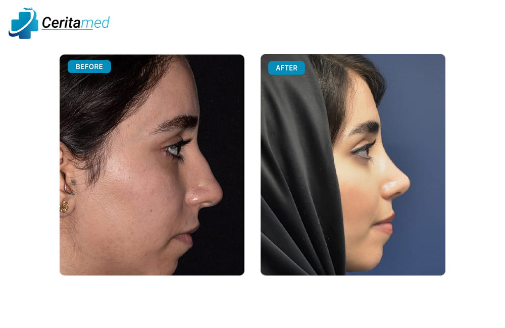 صورة قبل وبعد لعملية تجميل الأنف تُظهر التحسن الواضح في شكل الأنف من الجانب بعد جراحة الأنف في إيران.