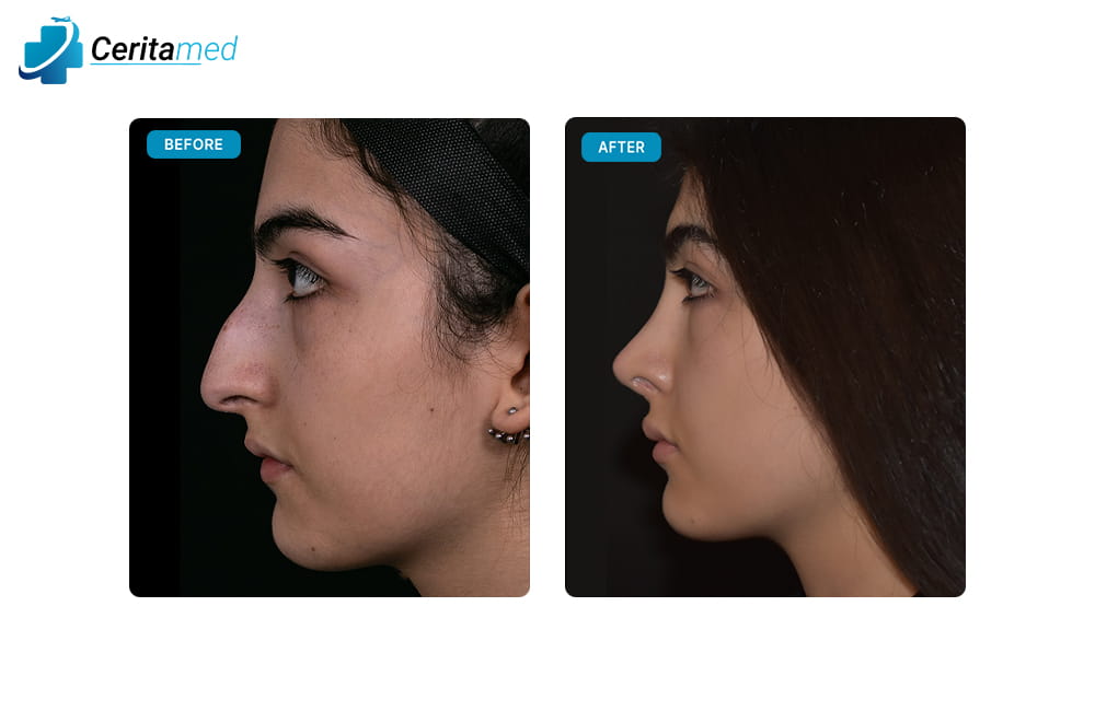 صورة قبل وبعد لعملية تجميل الأنف تظهر التحسن الواضح في شكل الأنف من الجهة الجانبية بعد جراحة الأنف في إيران.