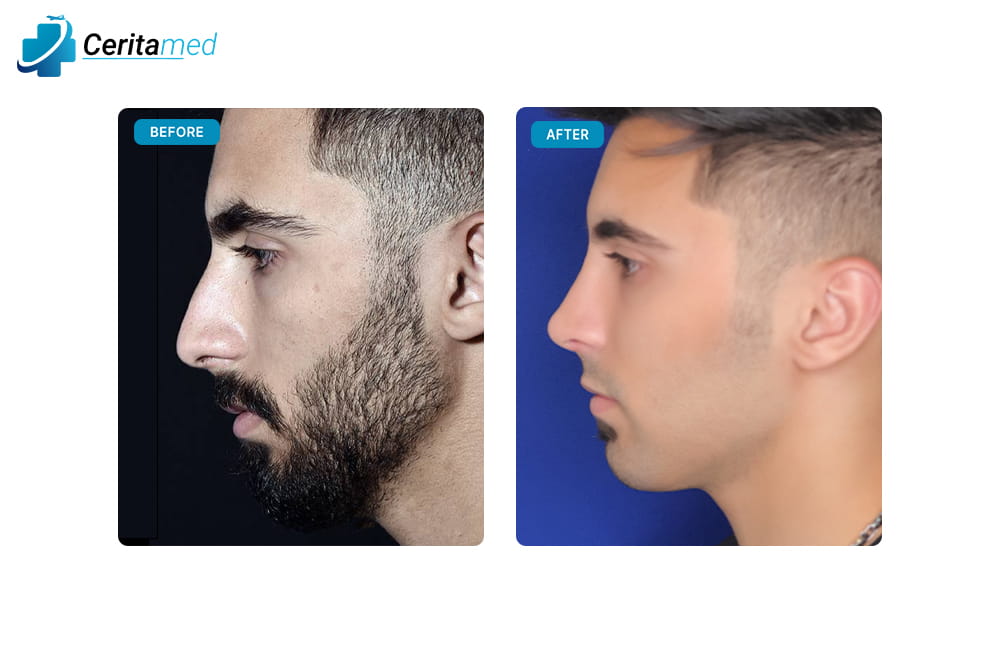 صورة قبل وبعد لعملية تجميل الأنف تظهر التحسن الجانبي في شكل الأنف بعد جراحة الأنف في إيران.