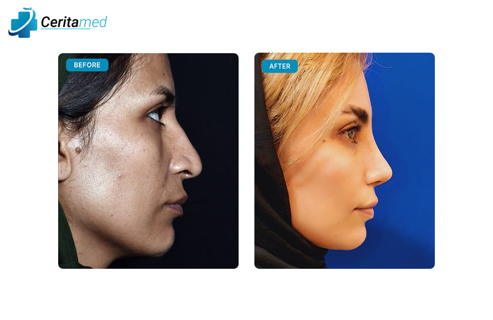 صورة قبل وبعد لعملية تجميل الأنف تظهر التحسن الجانبي في شكل الأنف بعد جراحة الأنف في إيران.