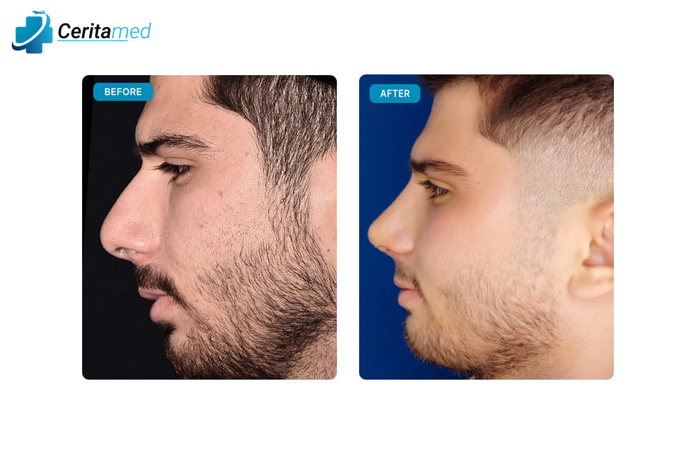 صورة قبل وبعد لعملية تجميل الأنف تظهر التحسن الجانبي في شكل الأنف بعد جراحة الأنف في إيران.