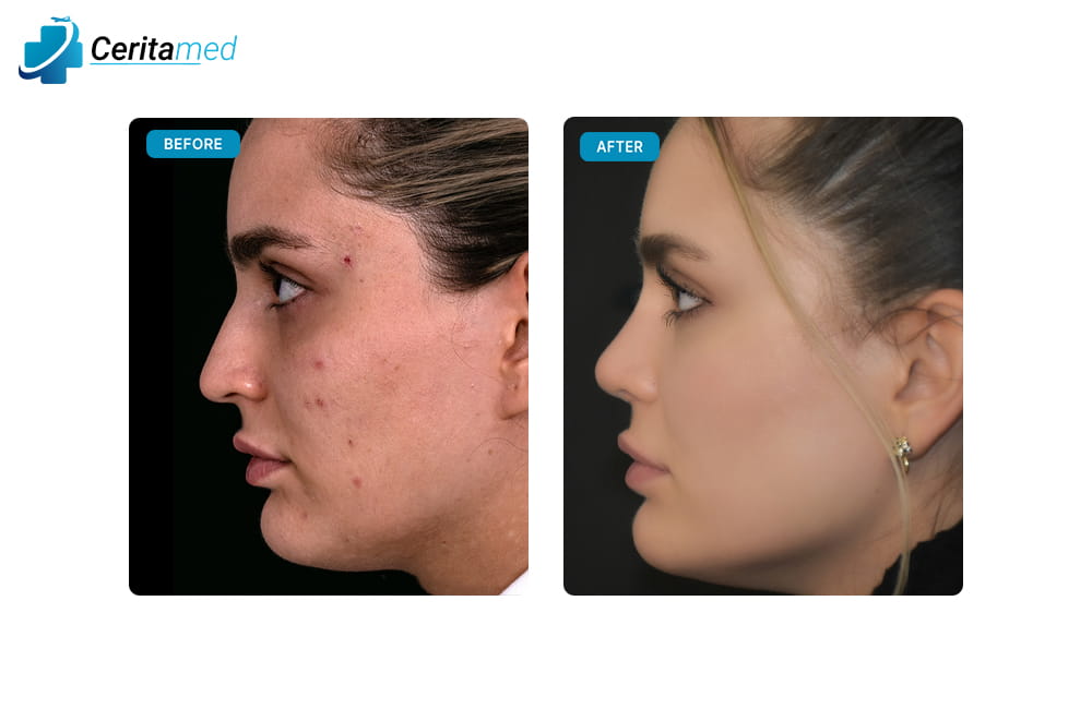 صورة قبل وبعد لعملية تجميل الأنف تظهر التحسين الجانبي في شكل الأنف بعد جراحة الأنف في إيران.
