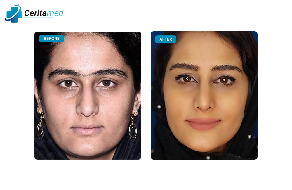 صورة قبل وبعد لعملية تجميل الأنف تظهر التحسينات الجمالية في ملامح الوجه بعد الجراحة في إيران.