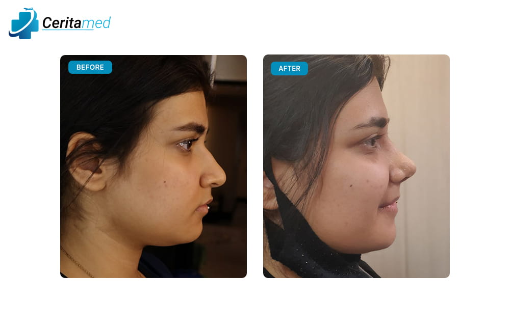 صورة قبل وبعد لعملية تجميل الأنف تظهر التحسينات الجمالية في الأنف بعد الجراحة في إيران