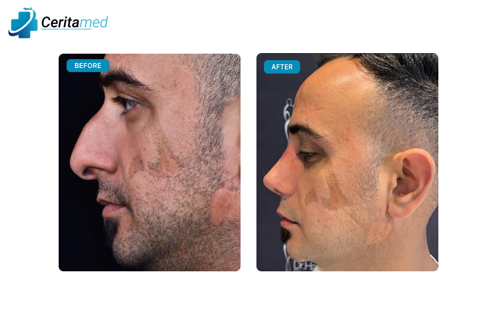 صورة جانبية لعملية تجميل الأنف للرجال في إيران تظهر التحسن الواضح في ملامح الأنف بعد الجراحة.