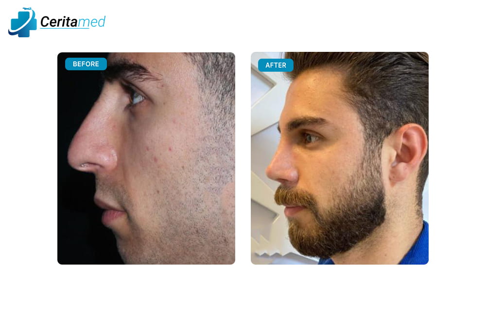 صورة جانبية لعملية تجميل الأنف للرجال في إيران تظهر التحسن الواضح في ملامح الأنف بعد الجراحة.