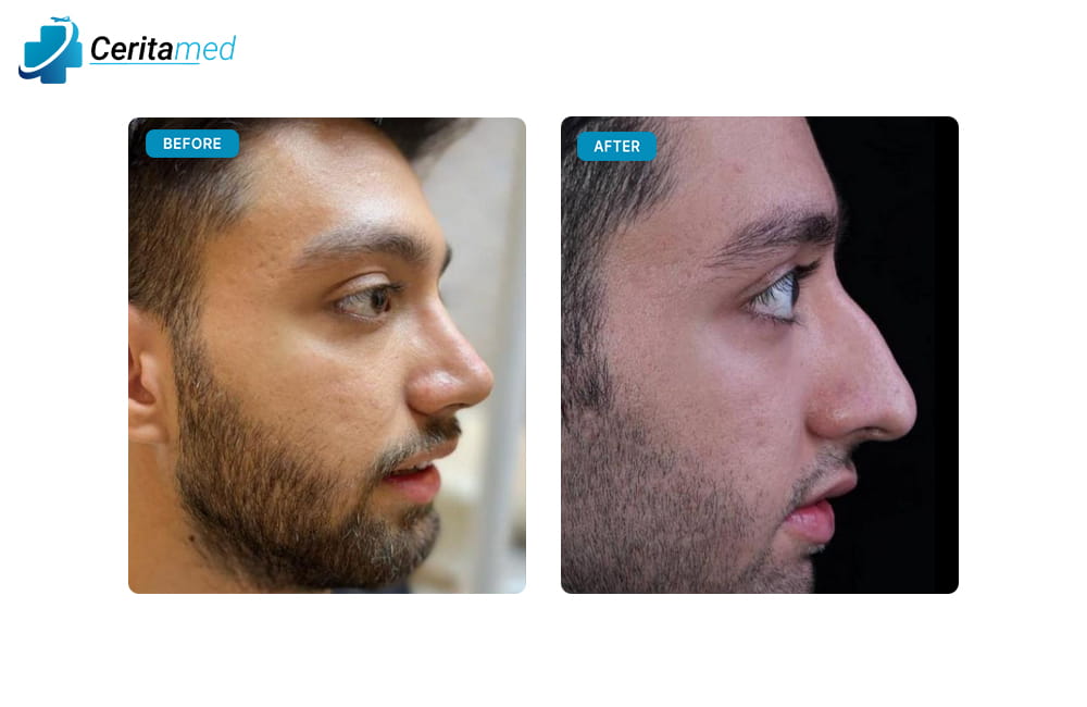 صورة جانبية لنتائج عملية تجميل الأنف للرجال في إيران تظهر التحسن الواضح في شكل الأنف بعد الجراحة.