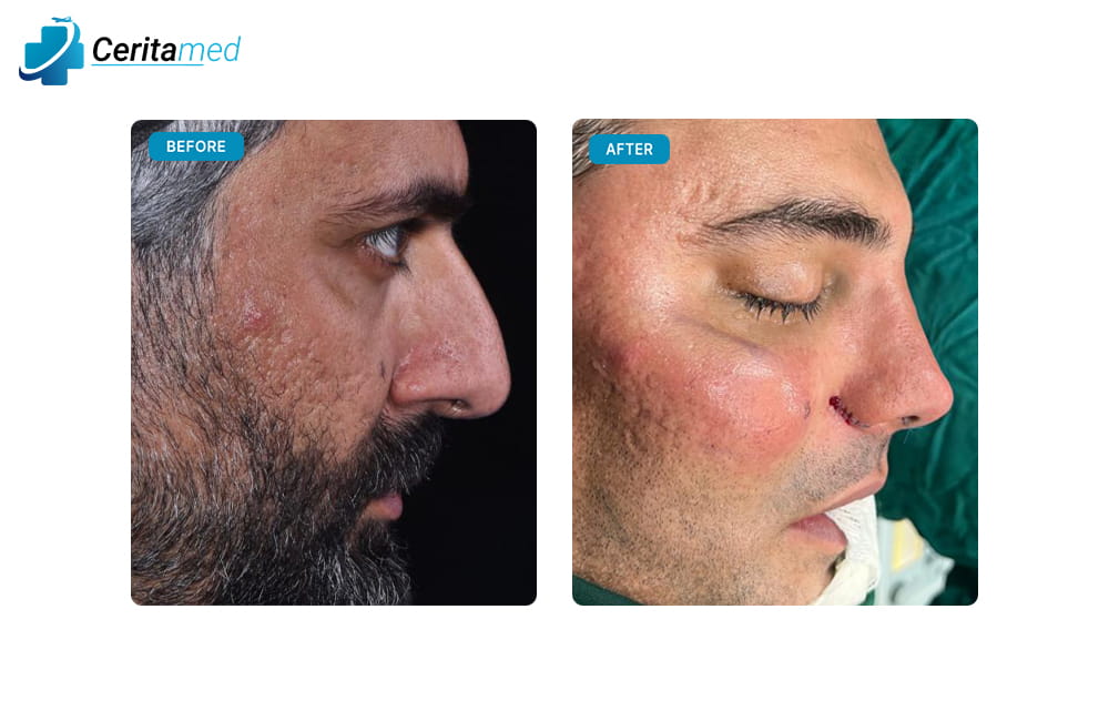 صورة جانبية لنتائج عملية تجميل الأنف في إيران تظهر تغيرات ما بعد الجراحة أثناء مرحلة الشفاء الأولية.