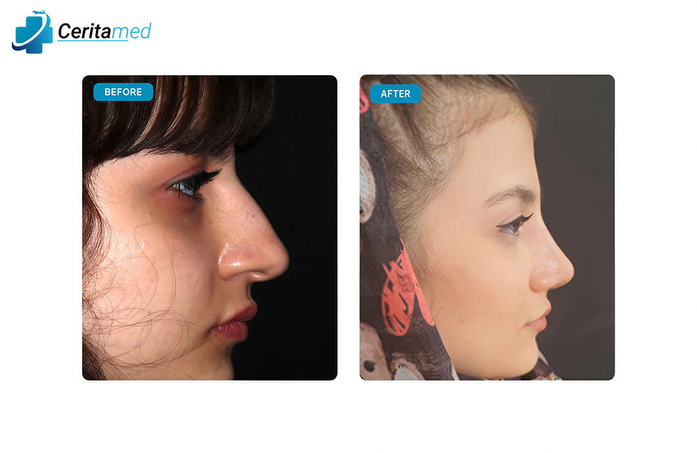 صورة جانبية لنتائج عملية تجميل الأنف في إيران تظهر التحسينات في شكل الأنف بعد الجراحة.