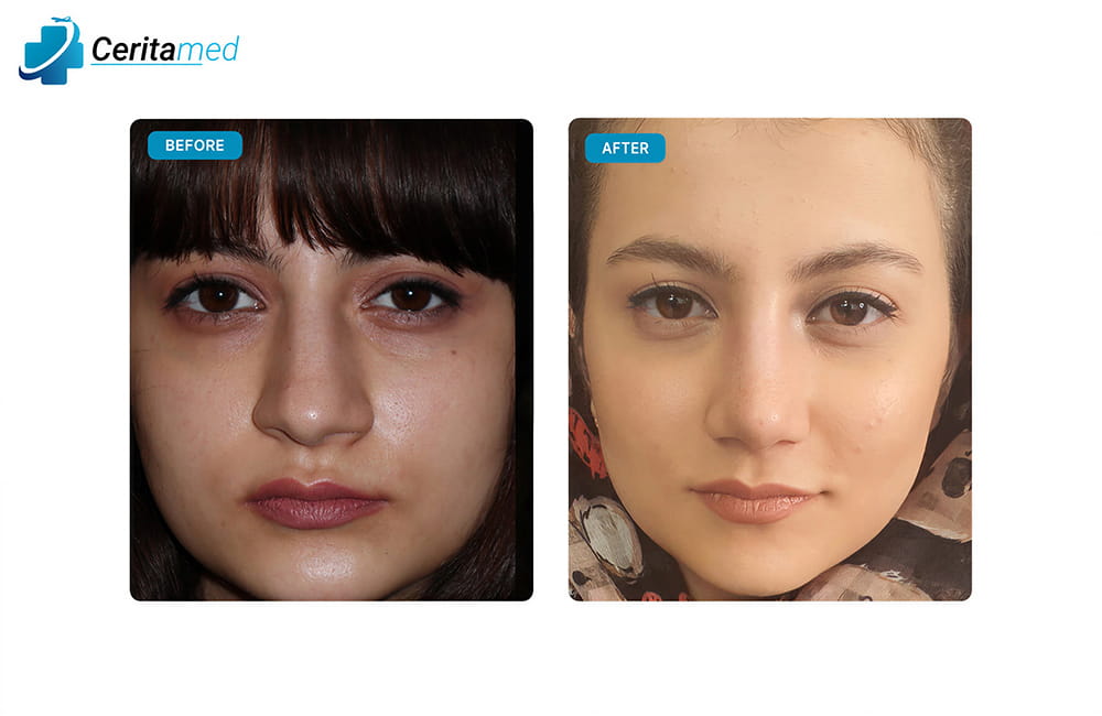 صورة أمامية لنتائج عملية تجميل الأنف في إيران تظهر التحسينات في شكل الأنف بعد الجراحة.