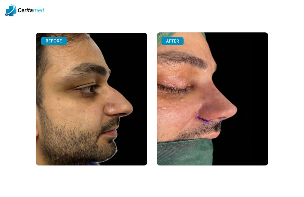 صورة جانبية لنتائج عملية تجميل الأنف في إيران تظهر التحسينات في شكل الأنف بعد الجراحة.