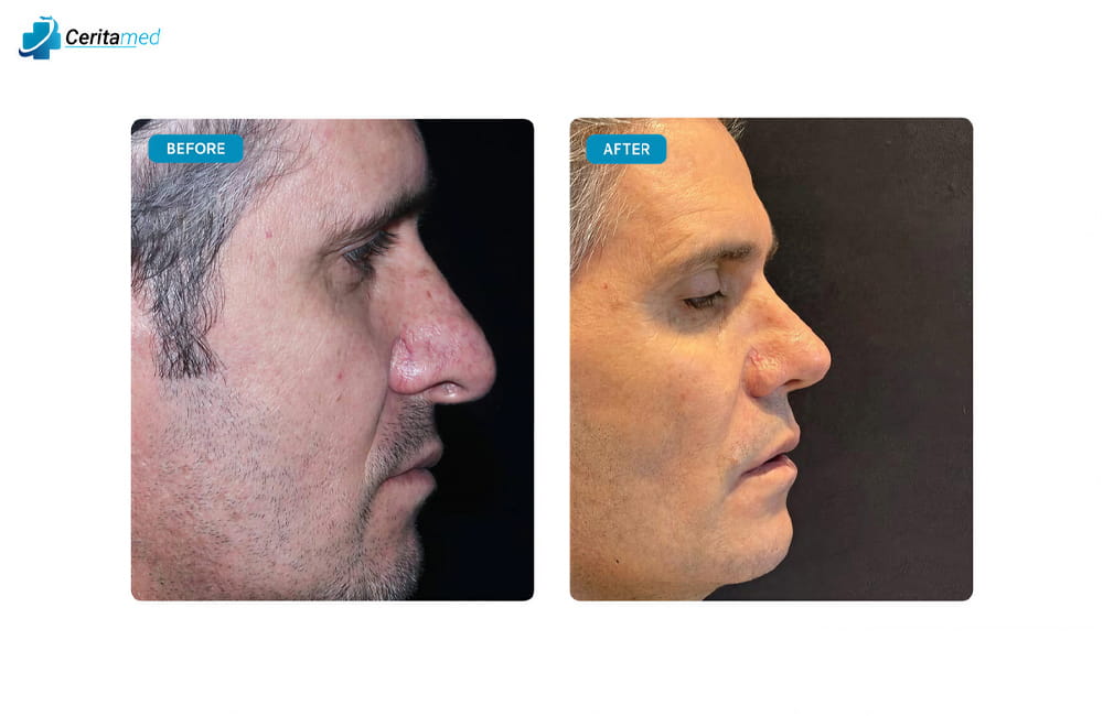 صورة جانبية لنتائج عملية تجميل الأنف في إيران تظهر التحسينات في شكل الأنف بعد الجراحة.
