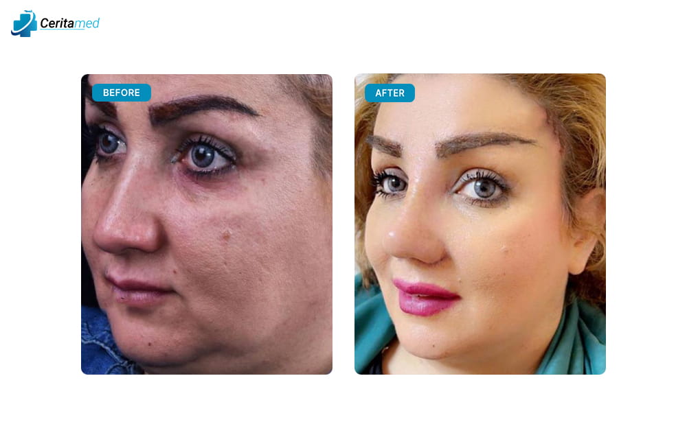 صورة جانبية تظهر التحسينات التي تمت على شكل الأنف بعد عملية تجميل الأنف في إيران.