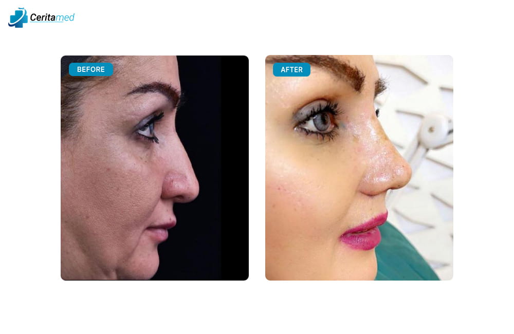 صورة جانبية تظهر التحسينات الملحوظة في شكل الأنف بعد عملية تجميل الأنف في إيران.