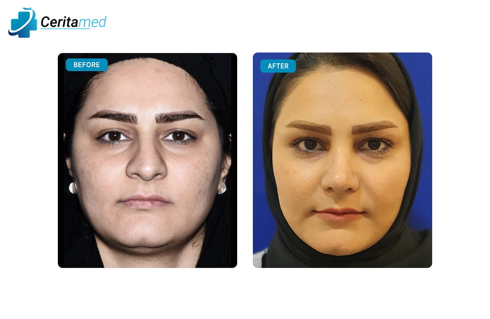صورة قبل وبعد جراحة تجميل الأنف في إيران تظهر الفرق في شكل الأنف وتحسينه بعد العملية، مع التركيز على التعديل الواضح في المظهر.