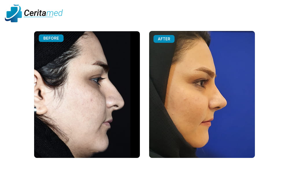 صورة قبل وبعد جراحة تجميل الأنف في إيران تظهر الفرق الواضح في شكل الأنف وتحسينه بعد العملية.