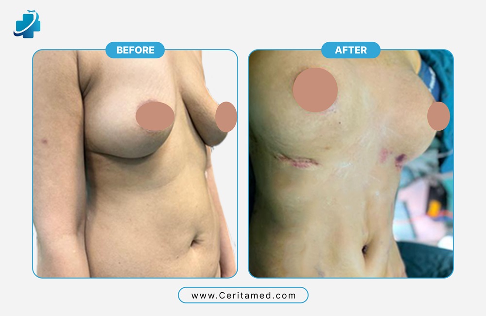 مظهر طبيعي للثدي بعد عملية التكبير في مراكز التجميل المتخصصة في إيران.