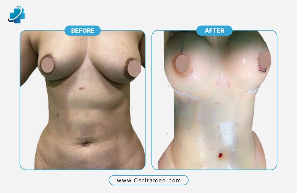 صورة مقارنة تظهر امتلاء الثدي وتناسقه بعد جراحة التجميل في إيران.