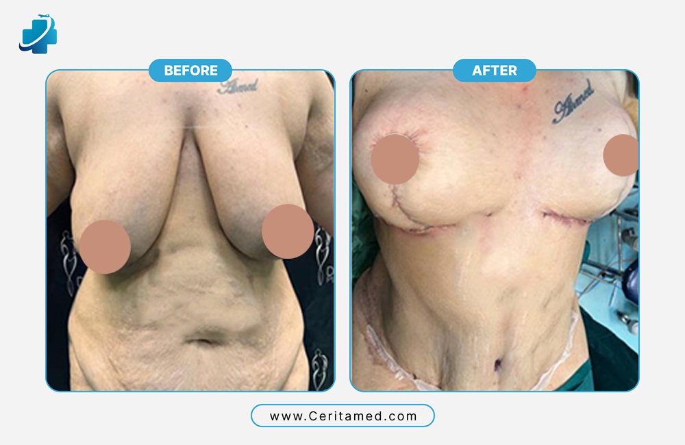 مقارنة نتائج عملية تصغير الثدي في إيران (قبل وبعد) تظهر تحسن شكل الصدر وتناسقه مع سريتامد.