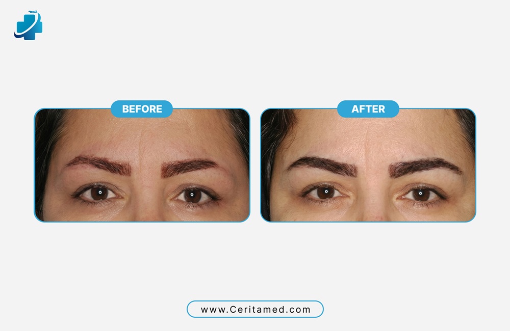 صورة مقارنة قبل وبعد لعملية زراعة الحواجب في إيران لدى سريتامد، تُظهر حاجبين طبيعيين وكثيفين.