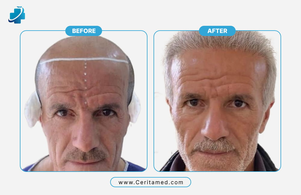 نتائج مذهلة لعملية زراعة الشعر في إيران للرجال المتقدمين في السن، تظهر كثافة الشعر الطبيعي قبل وبعد العملية في مركز سریتامد الطبي