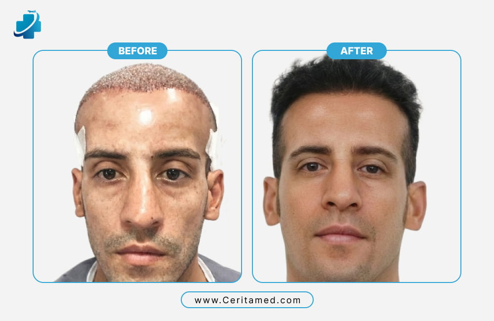 مقارنة دقيقة لخط الشعر الأمامي قبل وبعد زراعة الشعر في إيران، تظهر تقنيات الزراعة المتقدمة والنتائج الناجحة في مركز سریتامد.