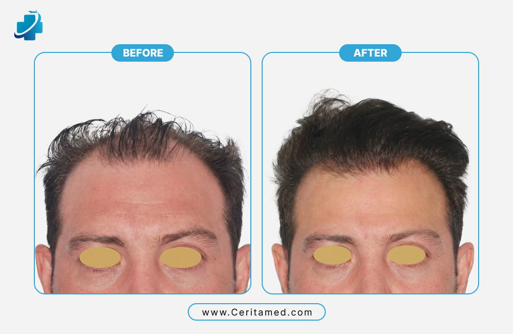 علاج تساقط الشعر الوراثي عبر زراعة الشعر في إيران؛ صورة مقربة تبرز الفرق الكبير في كثافة المنطقة الأمامية مع سریتامد
