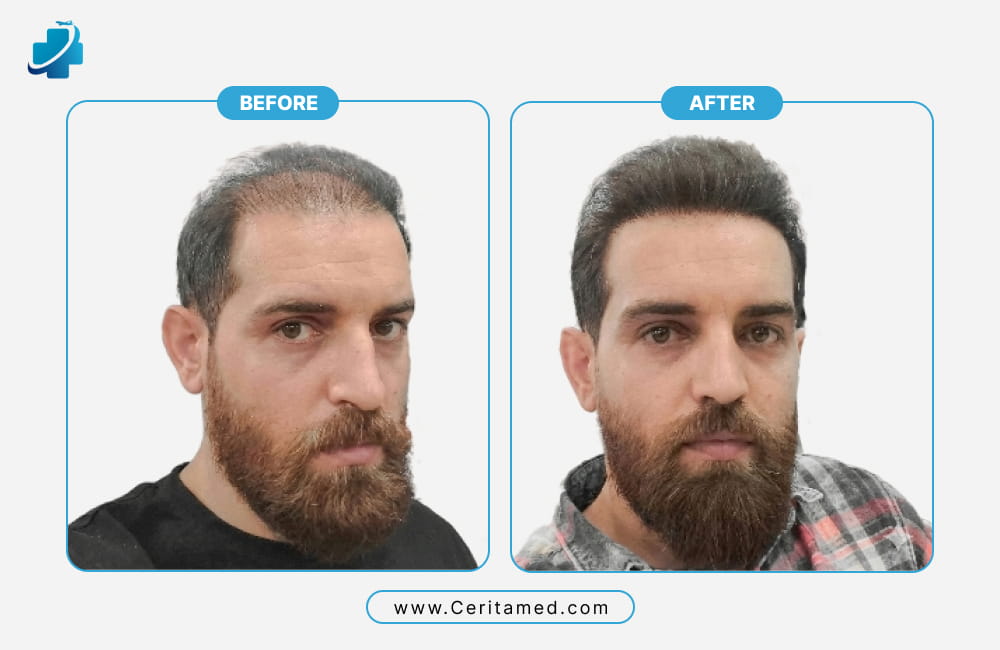 تكثيف الشعر وتعديل خط الجبهة من خلال زراعة الشعر في إيران؛ شاهد الفرق الواضح قبل وبعد العملية مع سریتامد