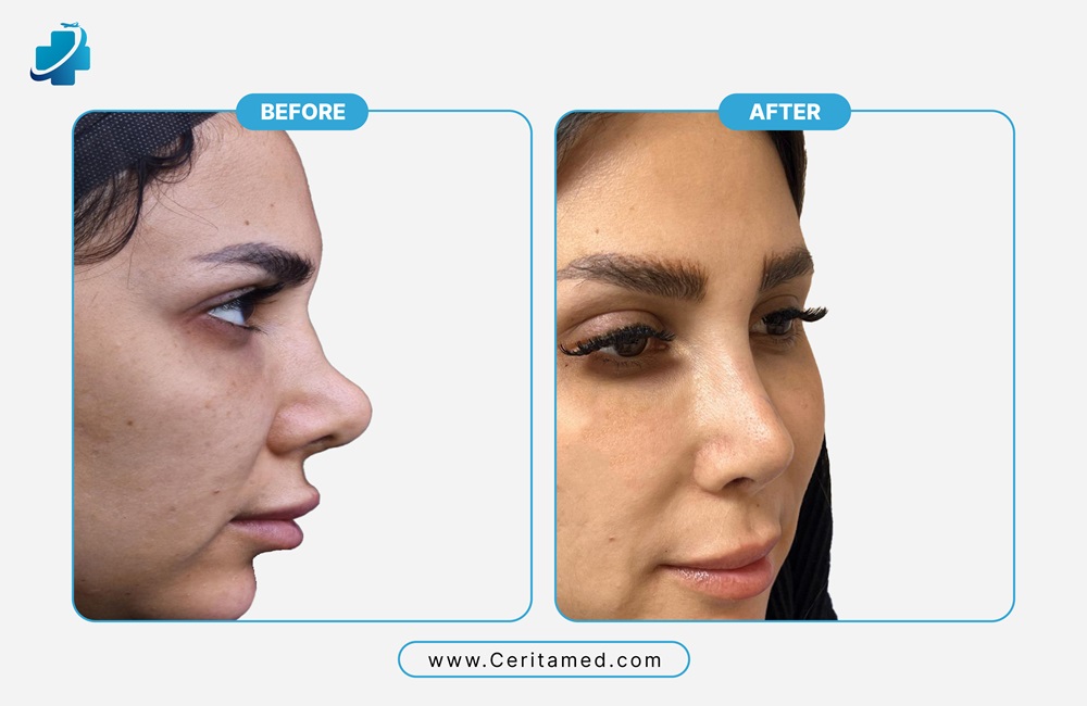 صورة قبل وبعد لعملية تجميل الأنف التصحيحي في إيران توضح تحسين شكل الأنف بشكل طبيعي