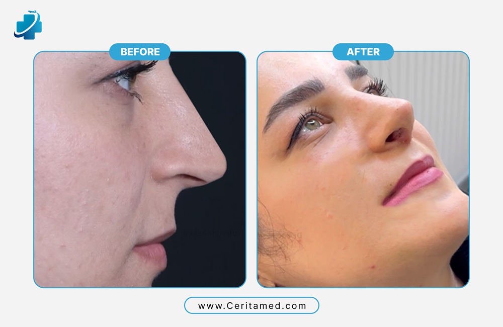 صورة قبل وبعد لعملية تجميل الأنف التصحيحي في إيران تظهر تحسين شكل الأنف بشكل طبيعي