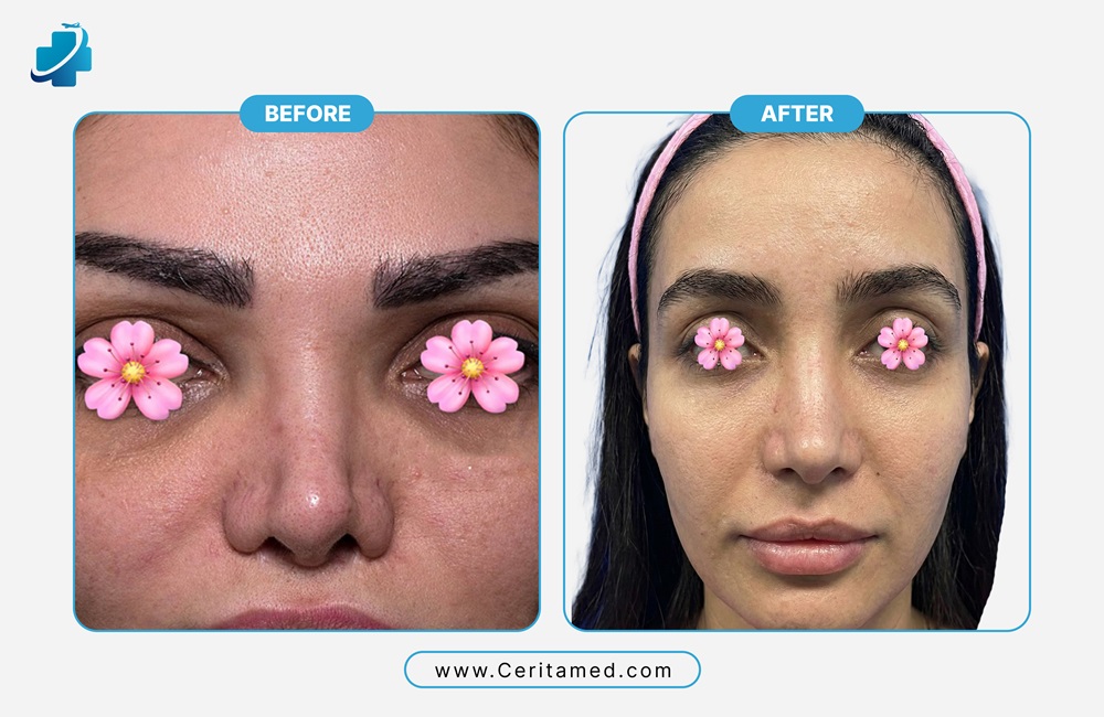 صورة قبل وبعد من الأمام لعملية تجميل الأنف التصحيحي في إيران تظهر تحسين شكل الأنف وتناسق الوجه