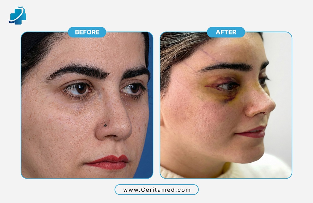 صورة قبل وبعد لعملية تجميل الأنف التصحيحي في إيران تظهر الكدمات الطبيعية خلال مرحلة التعافي بعد الجراحة