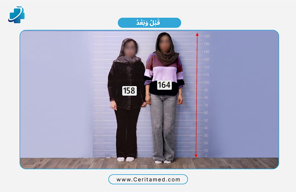نتيجة جراحة زيادة الطول للنساء قبل وبعد في إيران: زيادة الطول من 158 سم إلى 164 سم