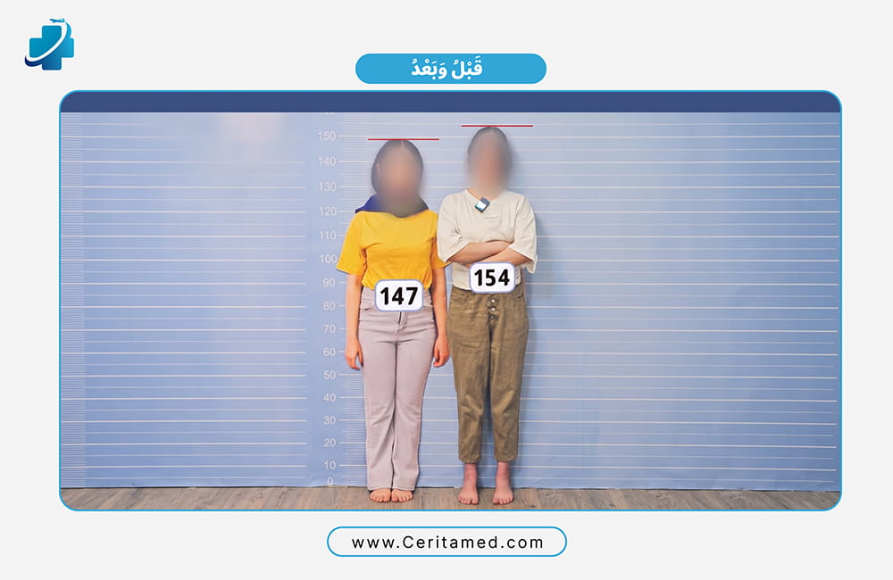 نتيجة تطويل الأطراف للنساء قبل وبعد في إيران: زيادة الطول من 147 سم إلى 154 سم