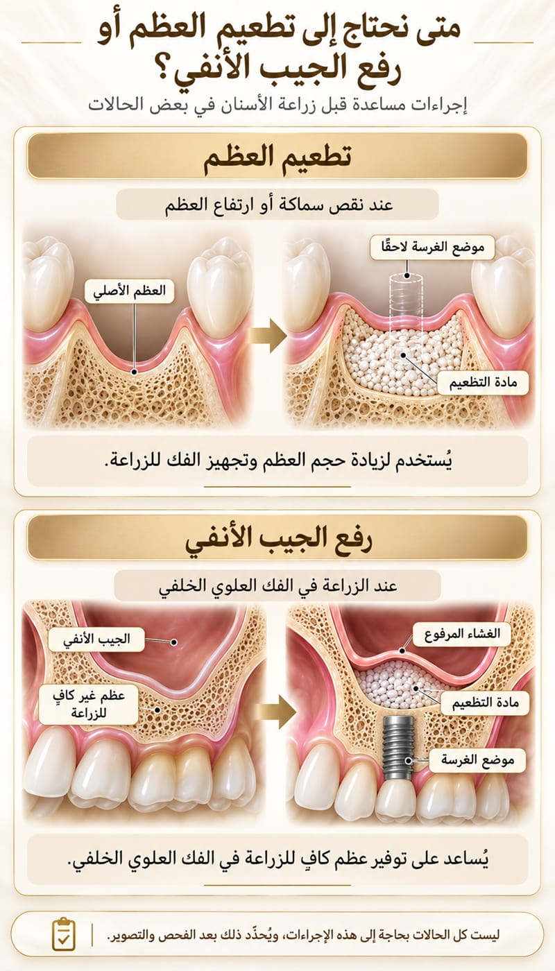 إنفوغرافيك عمودي يوضح تطعيم عظم الفك ورفع الجيب الأنفي قبل زراعة الأسنان في إيران لتحضير العظم وتوفير دعم للغرسات.