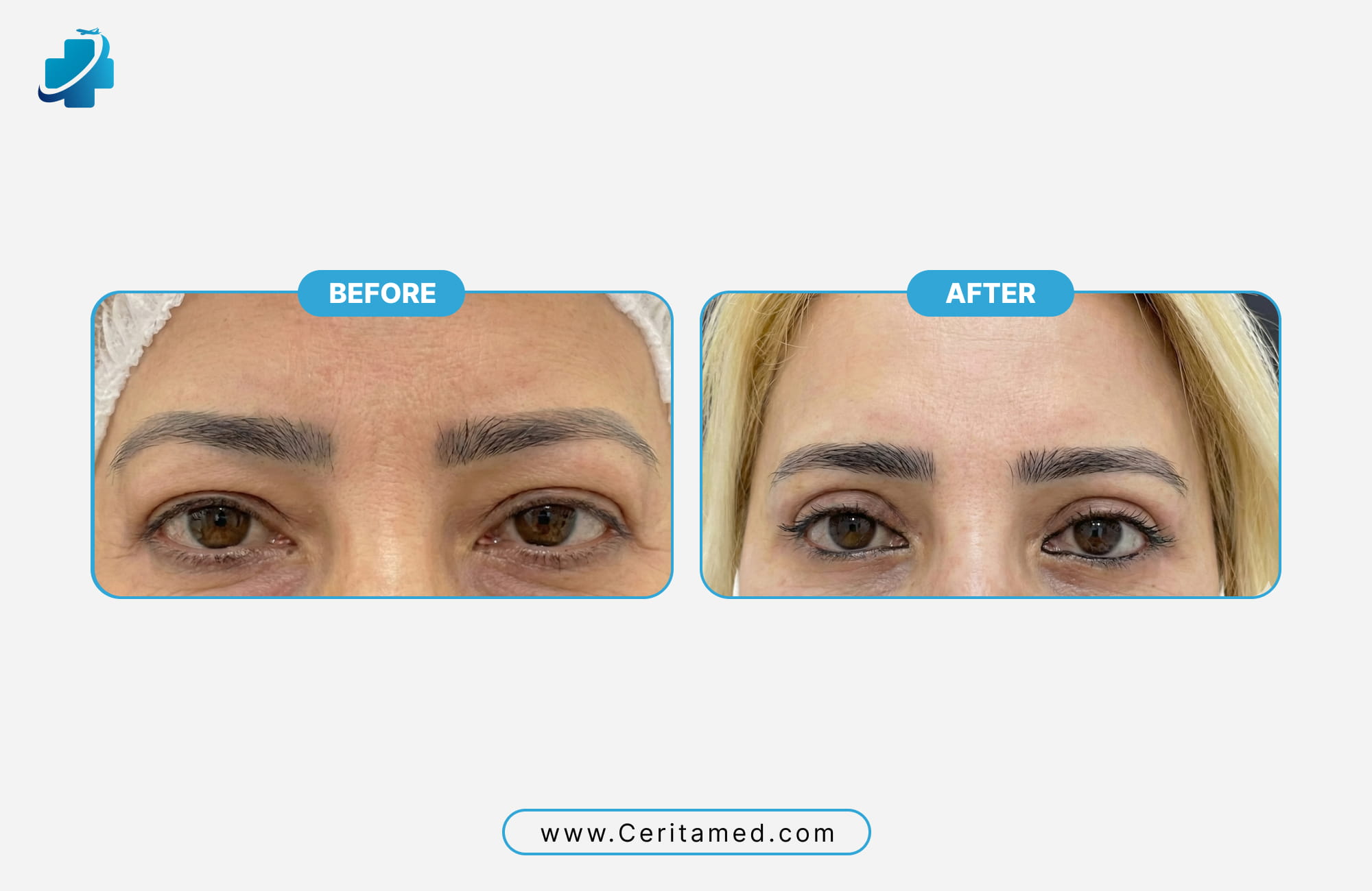 Best Blepharoplasty Results in Iran - Before and After by Ceritamed