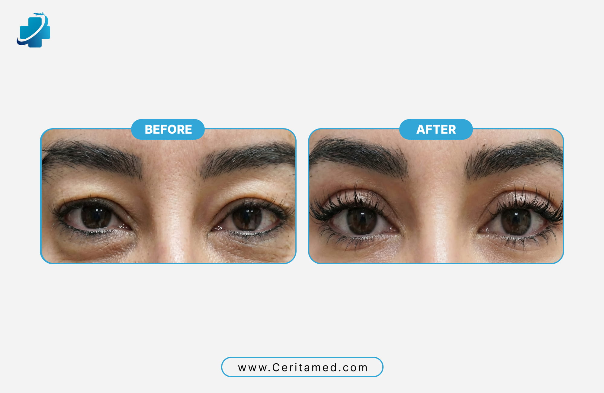 High-density eyebrow transplant results by Ceritamed showing before and after hair growth and improved brow shape.