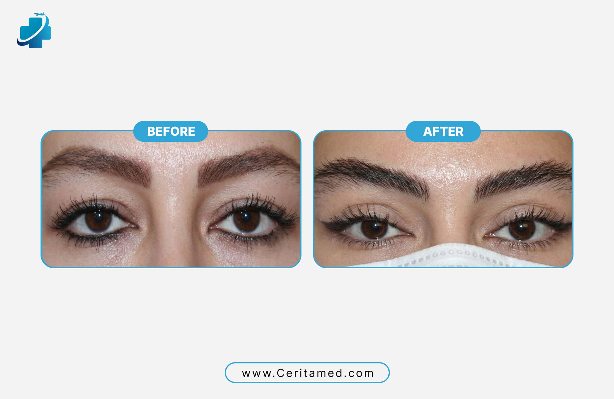 Patient results showing natural-looking eyebrow restoration and improved symmetry by Ceritamed.