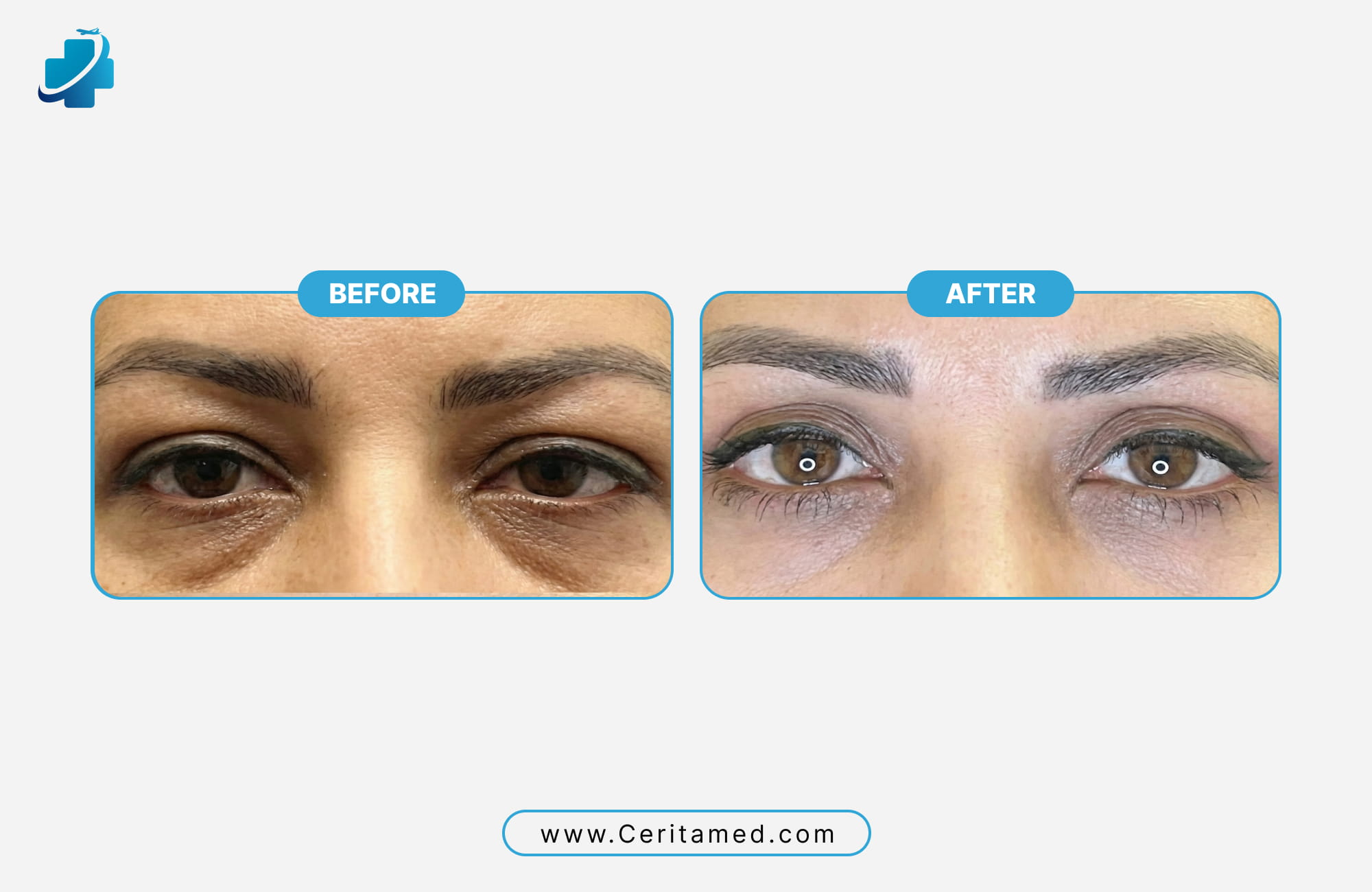 Side-by-side comparison of soft and natural feminine eyebrow transplant results by Ceritamed in Iran.